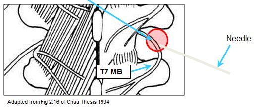 T5-T8 Medial Branch Blocks Target Point: Intertransverse space One-Needle Variation Steps: Insert needle to upper edge of the dorsal surface of rib.