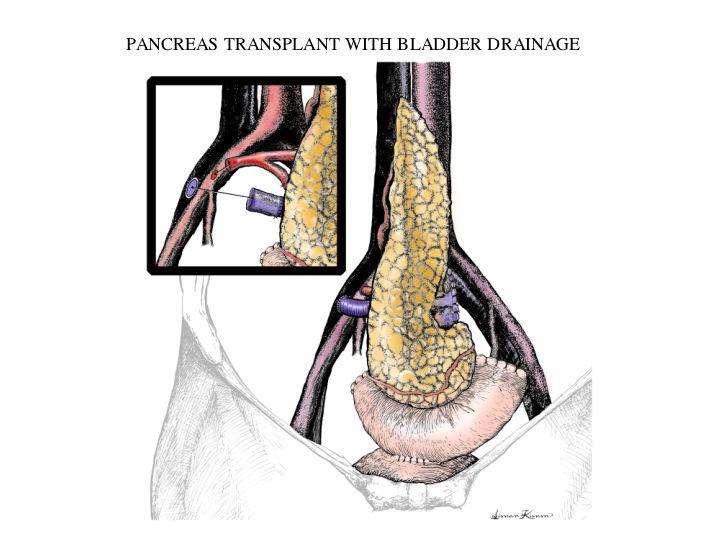 Bladder Drainage with Systemic Venous Anastomosis Advantage: Monitoring of urine amylase Disadvantage