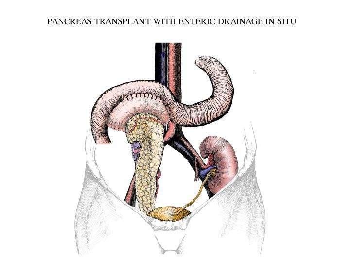 Urine in the pancreas - pancreatitis Enteric Drainage with Portal Venous Anastomosis Advantages: Avoid