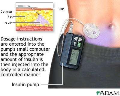 method: Right, Insulin