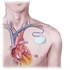 Pacemaker 1. The pacemaker can be identified as a hard lump beneath the skin. 2.