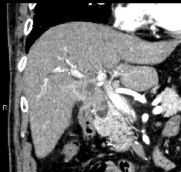 170 S. Ymd, et l. Hilr cholngiocrcinom with pncreticoiliry mljunction CASE REPORT A 75-yer-old mle ws referred to our institute for jundice nd tumor of the common ile duct.