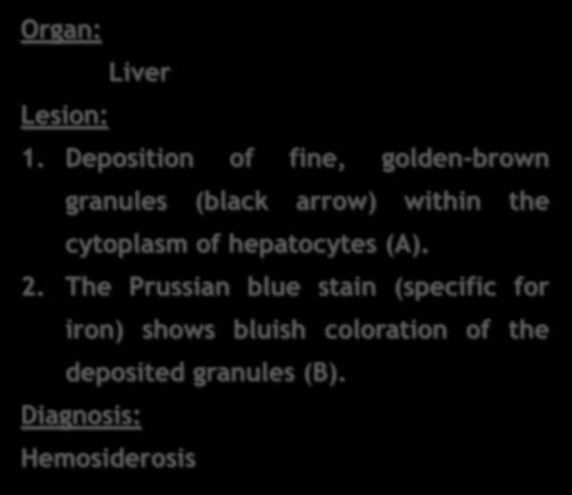 Organ: Liver Lesion: 1.