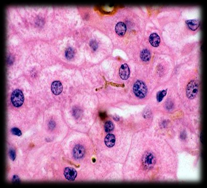Organ: Liver Lesion: Yellowish deposits are apparent