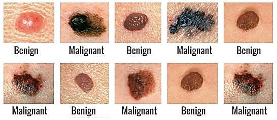 Benign nevus should be differentiated from Melanoma which is a malignant tumor (cancer) originated from