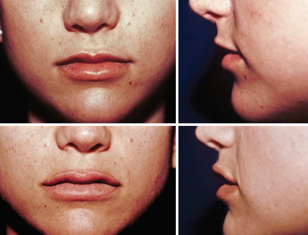 A C D Figure 1. Woman who underwent upper and lower lip augmentation with an injectable alloplast composed of polymethylmethacrylate microspheres 30 to 40 µm in diameter suspended in atelocollagen (3.
