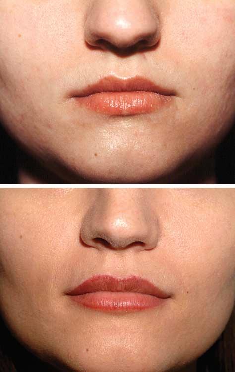 A A Figure 3. Woman who underwent upper and lower lip augmentation with an injectable alloplast composed of polymethylmethacrylate microspheres 30 to 40 µm in diameter suspended in atelocollagen (3.