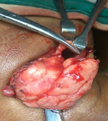 mass of submandibular fossa among which 84% of cases were asymptomatic and 16% presented with pain.
