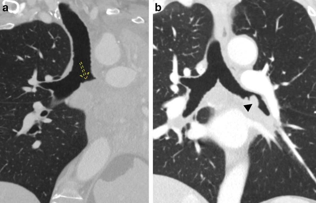 collapse (EDAC). Axial CT images of a patient with TBM demonstrating a normal-calibre right main bronchus during inspiration (b), which collapses with expiratory imaging (c).
