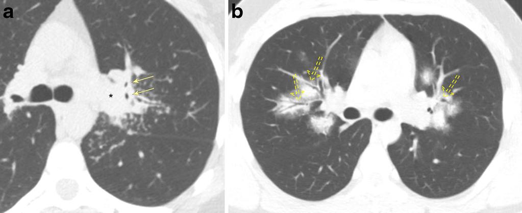 Insights Imaging (2017) 8:141 153 151 Fig. 18 Bronchial obstruction due to granulomatous disease.