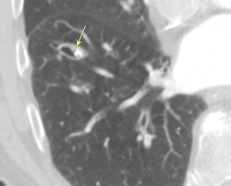 b Axial CT imaging of granulomatosis with polyangitis demonstrates infiltrative changes of the pulmonary parenchyma in a perihilar/bronchovascular distribution causing narrowing of the associated