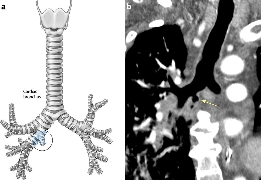 Insights Imaging (2017) 8:141 153 143 Fig. 2 Tracheal bronchus. a Illustrations of the tracheal bronchi types.