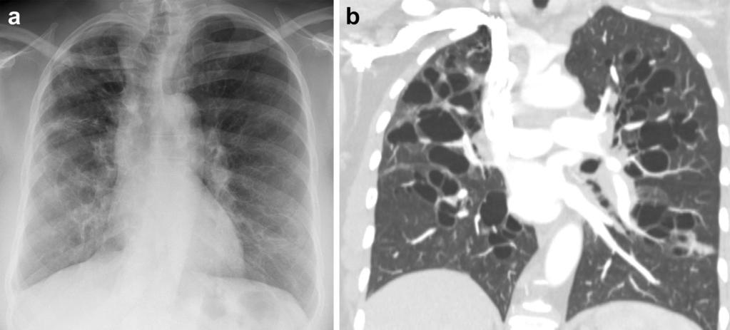 Insights Imaging (2017) 8:141 153 145 Fig. 4 Congenital pulmonary and bronchial malformation.
