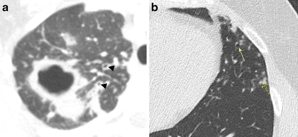 Insights Imaging (2017) 8:141 153 147 Fig. 8 Types of bronchiectasis. Axial CT imaging of three different patients demonstrating the bronchiectasis types.