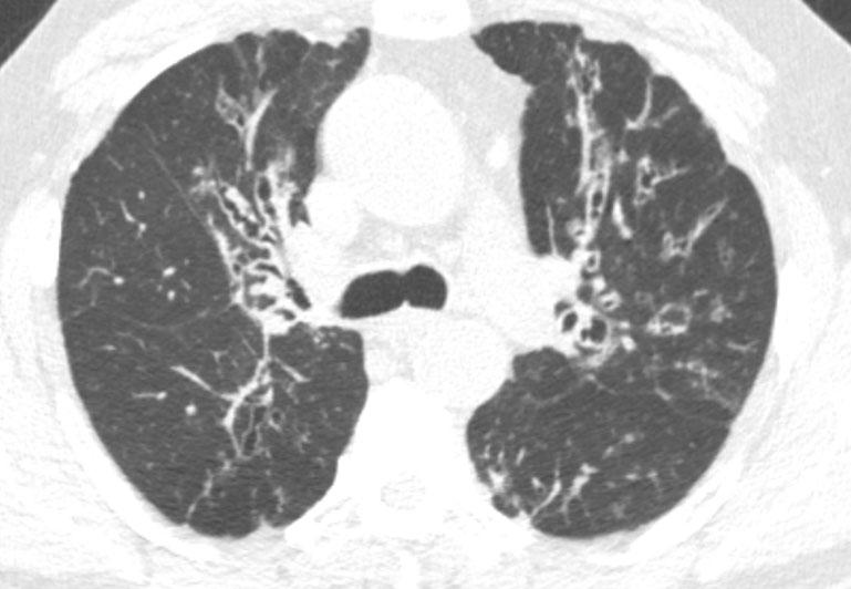 b Varicose-type bronchiectasis is characterised by a beaded or Bstring-of-pearls^ appearance with areas of alternating bronchial narrowing and dilatation.