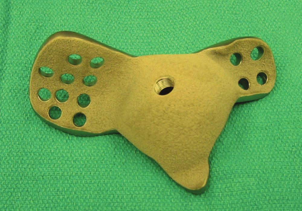 The flanges also feature holes for screws to achieve initial rigid fixation. The backside has porous coating for long-term biologic fixation. Fig. 2a Fig. 2b Fig. 3a Fig.