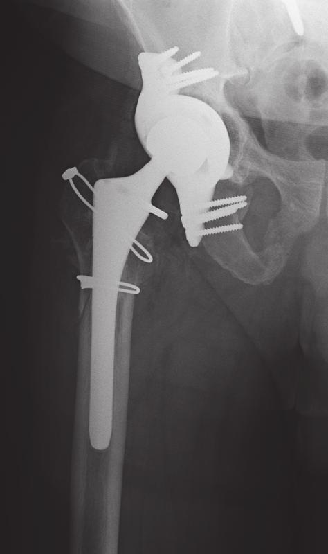 70 G. P. GOODMAN, C. A. ENGH JR Fig. 4 Anteroposterior radiograph (1.7 months post-operatively) showing triflange with screw fixation and trochanteric osteotomy used for exposure.