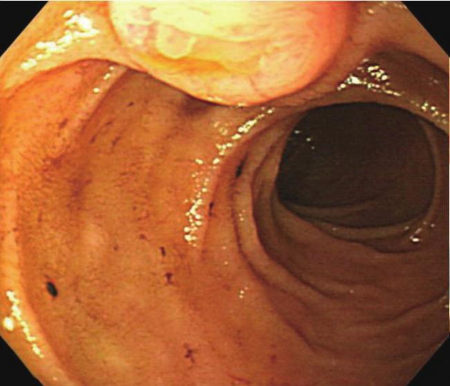 ERCP in B II Gastrectomy MATERIALS AND METHODS A total of 2,280 ERCP procedures were performed at our institution from October 2008 to June 2011.