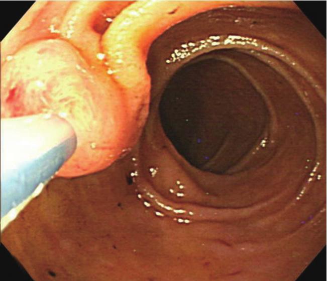 Routine endoscopic examination was first performed to identify the opening of the afferent loop and papilla in most patients except for those experiencing an emergent situation such as severe