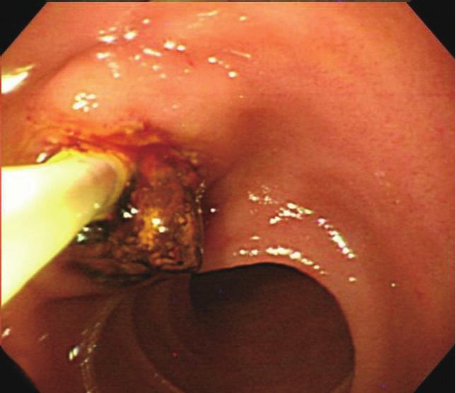 (EST) or endoscopic papillary balloon dilatation (EPBD) in a patient with Billroth II gastrectomy.