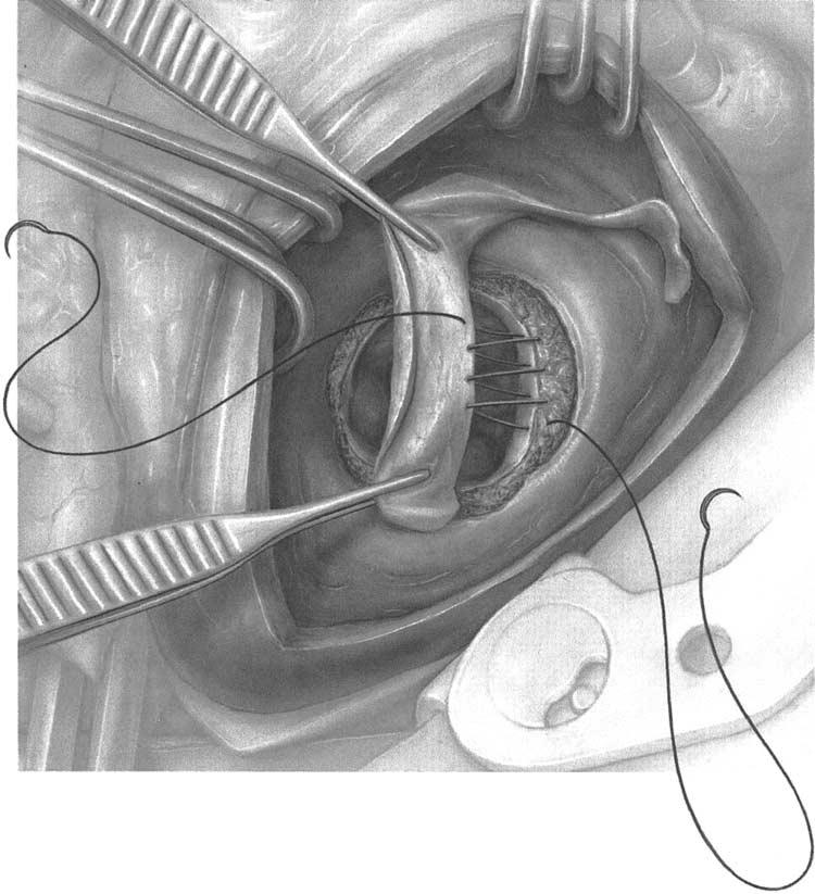24 CHRISTOPHER M. FEINDEL 2 A circumferential patch of bovine pericardium is sewn around the annulus with a 3-0 polypropylene suture on a large 1 2 circle taper needle.