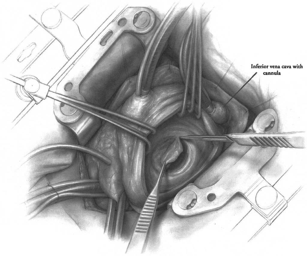 MITRAL VALVE REPLACEMENT 15 SURGICAL TECHNIQUE ABSCESS CONFINED TO THE POSTERIOR MITRAL