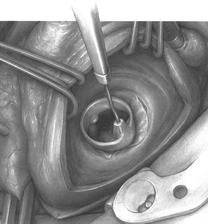 MITRAL VALVE REPLACEMENT 19 5 The annulus is measured to determine the size of prosthesis to insert.