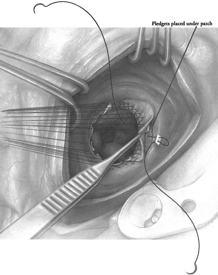 20 CHRISTOPHER M. FEINDEL 6 Pledgeted 2-0 braided polyester valve sutures on 1 2 circle needle are placed around the annulus.