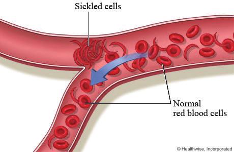 WHAT IS SCD? SCD or sickle cell anemia is a hereditary genetic disease characterized by the presence of abnormal crescent-shaped red blood cells.
