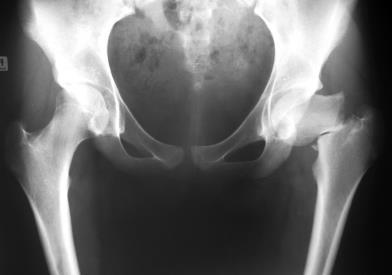 Fracture Groin, medial