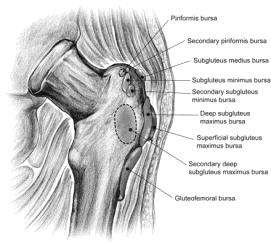 adjacent areas Glut medius tendonopathy, partial gluteal tears, DJD/OA hip, Lumbar referral TROCHANTERIC