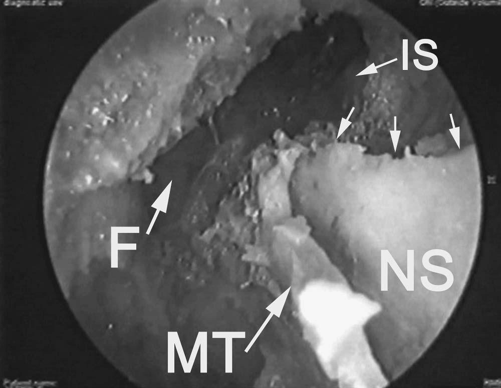 92 Chapter 4 Figure 55 Endoscopic view after medial endoscopic enlargement of the frontal sinus ostium (F).