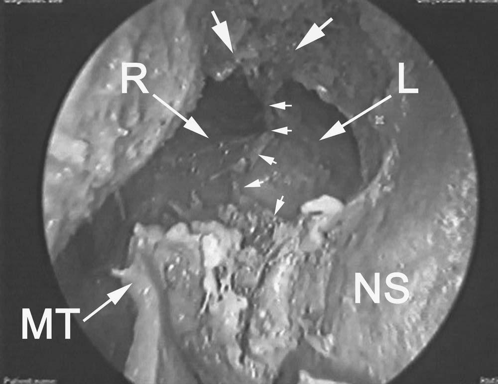 94 Chapter 4 Figure 57 Endoscopic view showing the right (R) and left (L) frontal sinus after removal of the intersinus septum (small arrows).