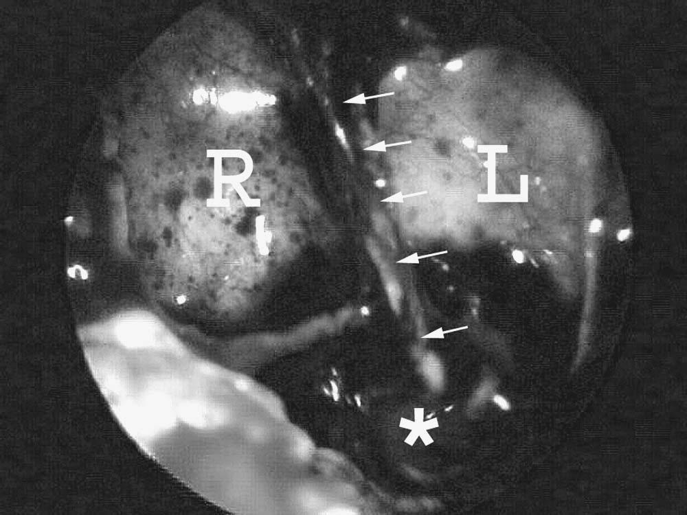 98 Chapter 4 Figure 61 Endoscopic view. R = right sphenoid sinus. L = left sphenoid sinus. Small arrows denoted the resected edge of the sphenoid intersinus septum.