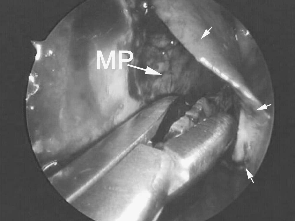 24 Chapter 3 Figure 14 Endoscopic view showing the ipsilateral mucoperichondrial flap (arrows) is elevated toward the inferior turbinate.