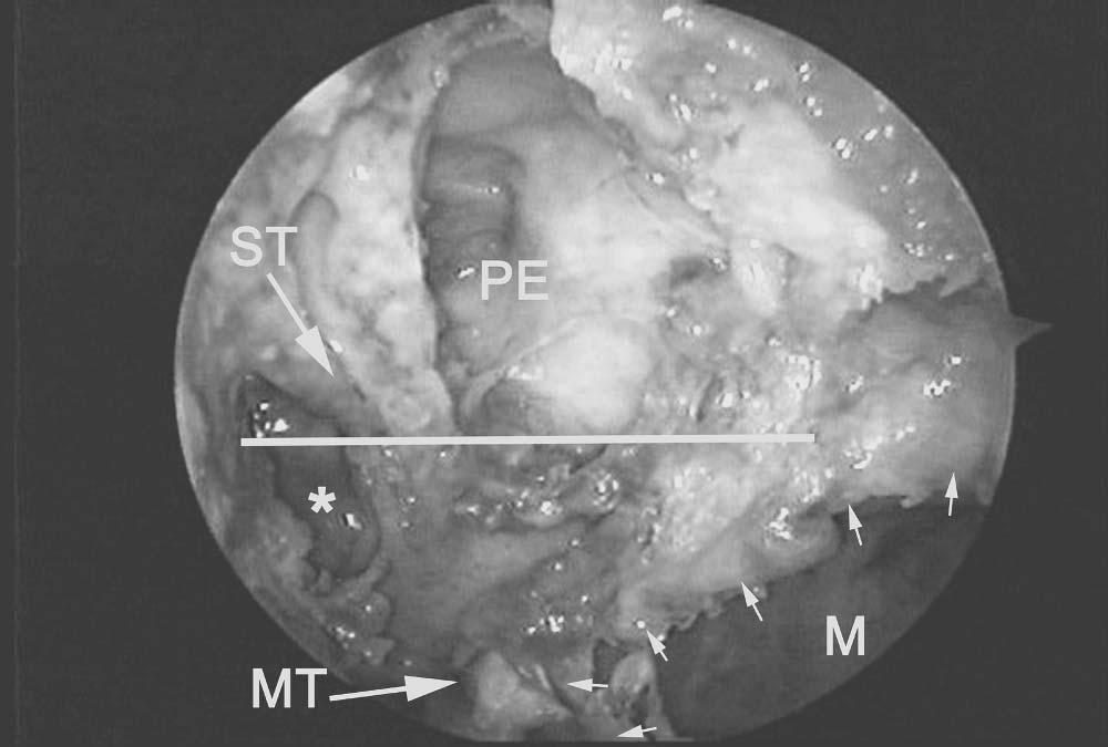 54 Chapter 3 Figure 32 Endoscopic view showing the sphenoid ostium (asterisk), which has been enlarged inferiorly and medially. ST = superior turbinate. MT = middle turbinate. PE = posterior ethmoid.