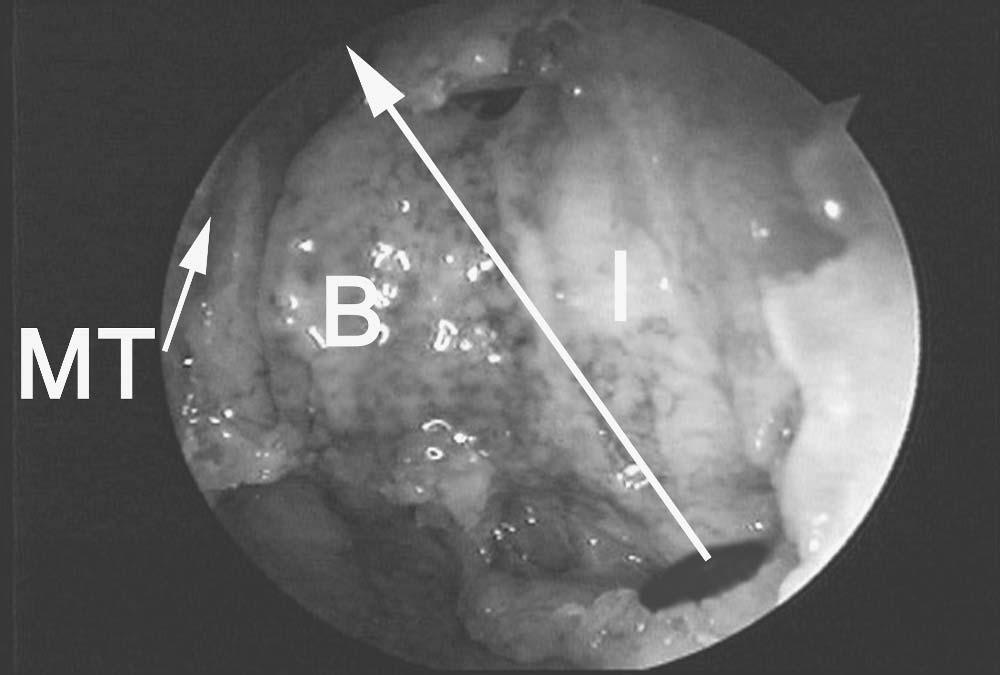 Basic Dissection 59 inadvertent penetration into the anterior cranial fossa at the level of the anterior ethmoid artery.
