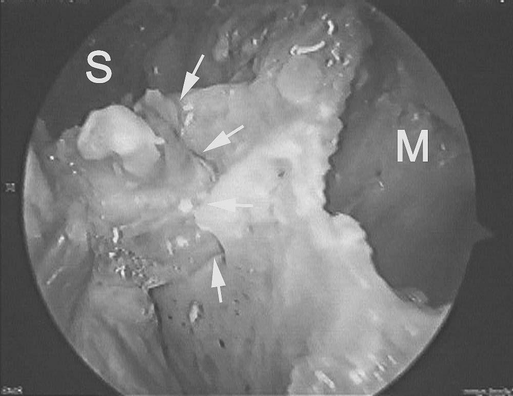 66 Chapter 4 Figure 38 Endoscopic view showing the sphenopalatine foramen (arrows)