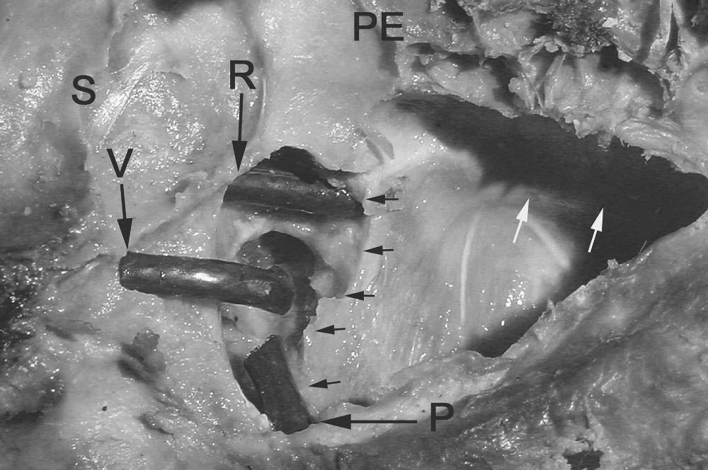 68 Chapter 4 Figure 40 Sagittal view of the pterygomaxillary fossa.