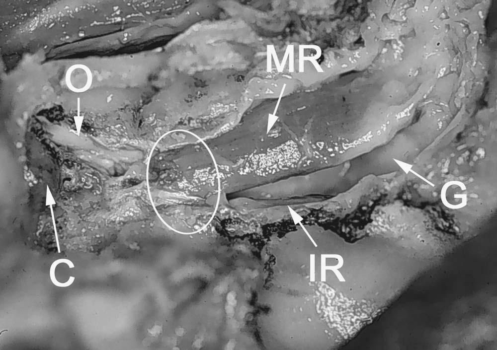 86 Chapter 4 F. Orbital Dissection (Figures 52 and 53) Removal of the periorbita and fat reveals the medial rectus muscle coursing along the medial wall of the orbit.