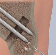 There is a risk of the proximal portion of the pin (the blunt end) protruding through the lateral cortex. Does the knee have to be flexed at 1 0 to drill the tunnel? 3 What is lateral bone stock?