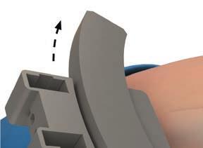 RIGIDFIX CURVE Cross Pin System Frequently Asked Questions (FAQ) Summary 3 Do I need to remove the Bone Gauge Pin and Arc Attachment before drilling the Sleeves? This is surgeon preference.
