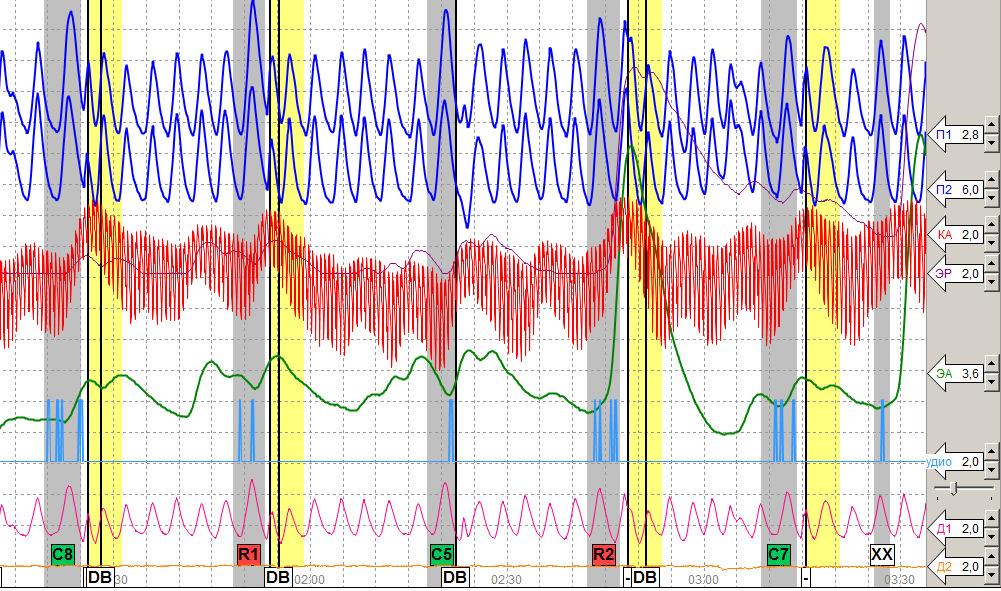 4 Figure 4: Breathing manipulation during testing, again only to comparison questions. On this Internet site it states, "Breath affects the pulse and heart rate monitored by sensors.