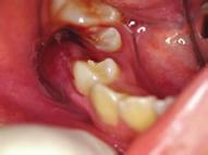 2 Case Reports in Medicine (a) (b) (c) Figure 1: (a) Preoperative intraoral photograph showing a gingival abscess in the mandibular right second premolar.
