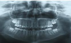 (c) X-ray showing an immature open apex and enlargement of the periodontal ligament space and extensive radiolucency in the periradicular region in the mandibular right second premolar.