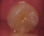(b) The central cusp of the mandibular right second premolar had been