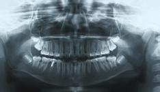 (c) Panoramic X-ray showing the formation of a dentin bridge and thickening of the canal walls and establishment of the periodontal ligament space and lamina dura in the mandibular right second