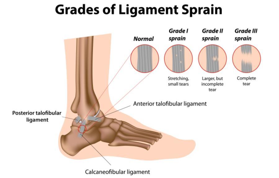 Ankle sprains Severity Location of the sprain: Lateral ankle