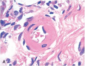 HYPERTENSIVE VASCULAR DISEASE Morphology: Hyaline arteriolosclerosis