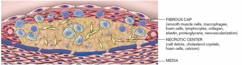 ATHEROSCLEROSIS Atherosclerosis is characterized by the presence of intimal lesions called